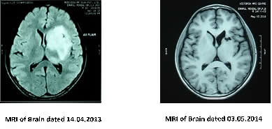 mri_of_brain